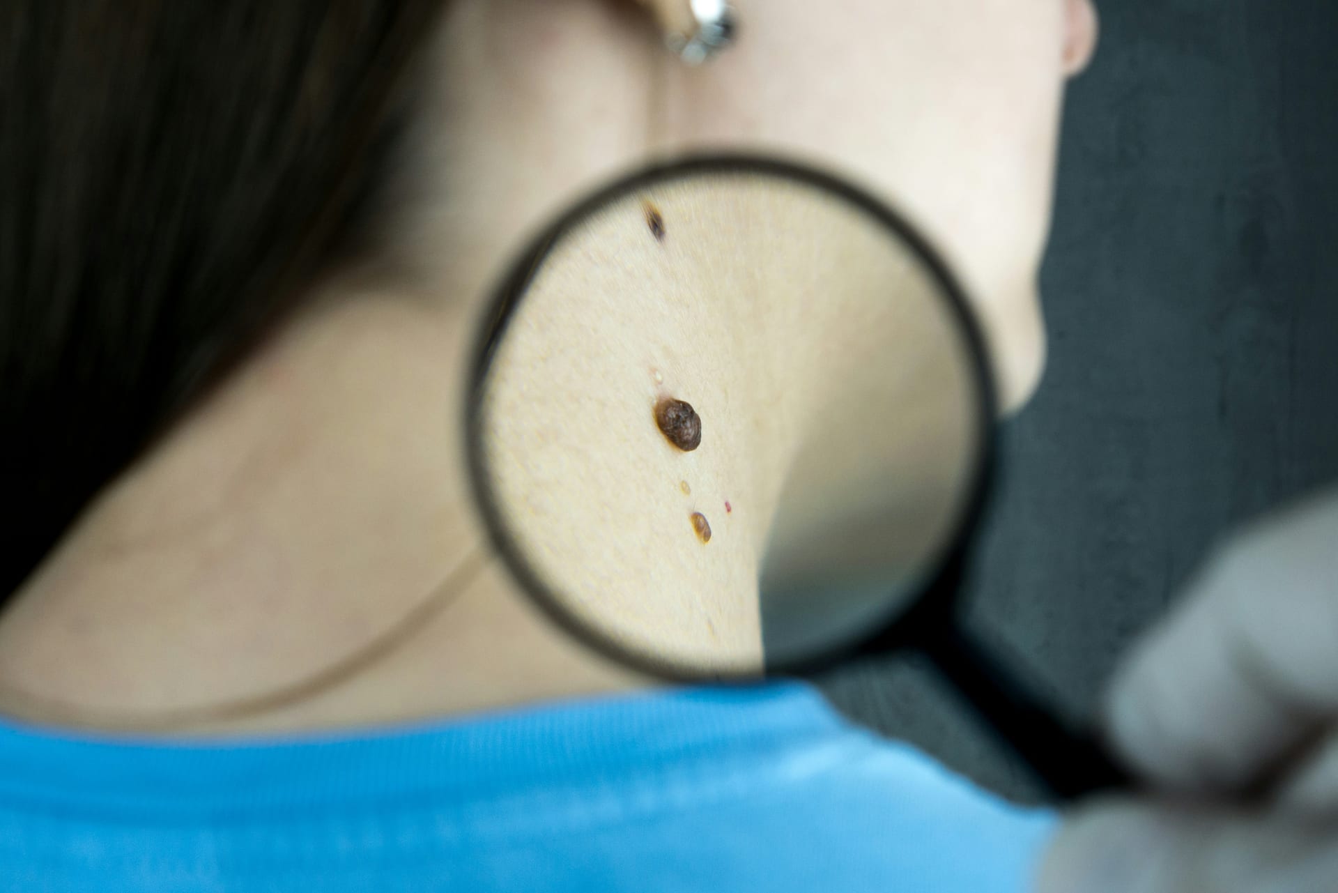 Una lupa acerca la piel de la espalda de una persona durante una revisión dermatológica.